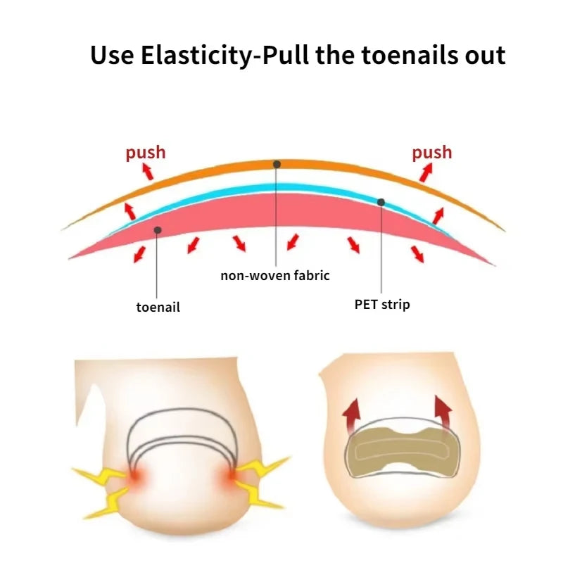 Nail Correction Stickers Ingrown Toenail Corrector Patches Paronychia Treatment Recover Corrector Pedicure Tools