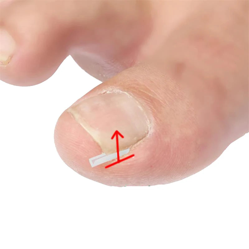 10Pcs Paronychia Treatment Recover Corrector Pedicure Tools Nail Correction Stickers Ingrown Toenail Corrector Patches